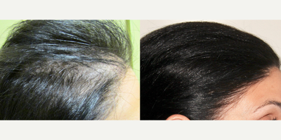 PRP for Hair Loss before and after photo