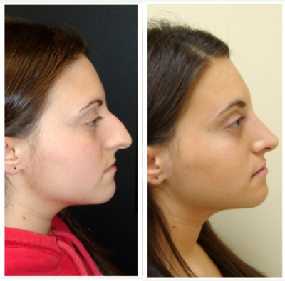 Rhinoplasty before and after photo