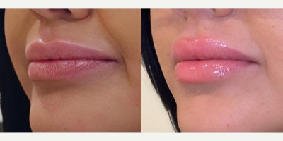 Dermal Fillers before and after photo