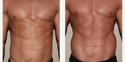 Emsculpt before and after photo