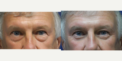 Eyelid Surgery before and after photo