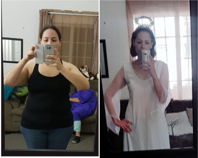Gastric Bypass before and after photo