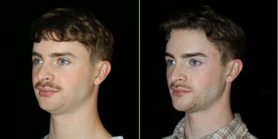 Genioplasty before and after photo