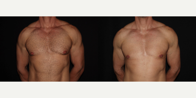 Gynecomastia Surgery before and after photo