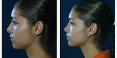 Revision Rhinoplasty before and after photo