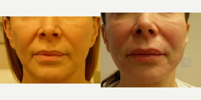 Thread Lift before and after photo