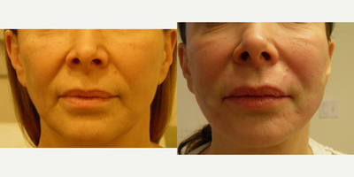 Thread Lift before and after photo