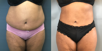 Brazilian Butt Lift before and after photo