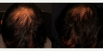 PRP for Hair Loss before and after photo