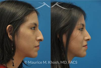 Rhinoplasty before and after photo