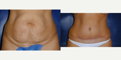 Tummy Tuck before and after photo