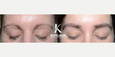 Eyebrow Transplant before and after photo