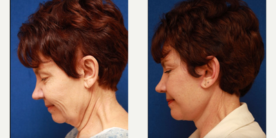 Facelift before and after photo