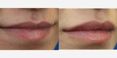 Lip Fillers before and after photo