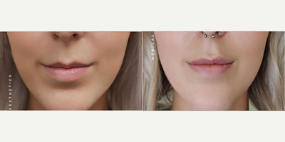 Lip Fillers before and after photo