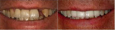 Porcelain Veneers before and after photo