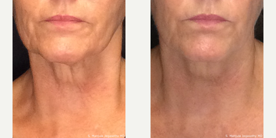 Dysport before and after photo
