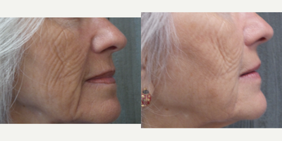 Exilis before and after photo