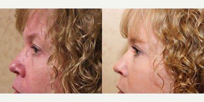 Eyelid Surgery before and after photo