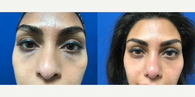 Eyelid Surgery before and after photo