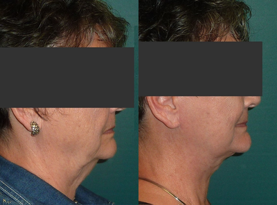 Facelift before and after photo