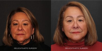 Liposuction before and after photo