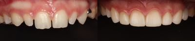 Porcelain Veneers before and after photo