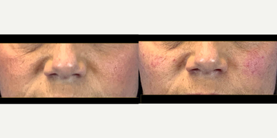 Restylane Lyft before and after photo
