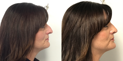 Rhinoplasty before and after photo