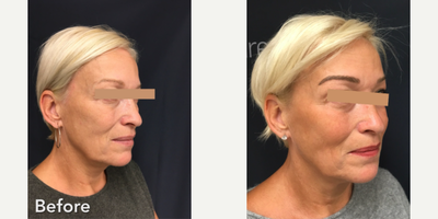Skin Tightening before and after photo