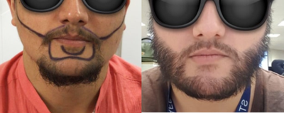 Beard Transplant before and after photo