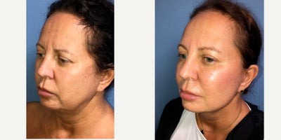 before and after image