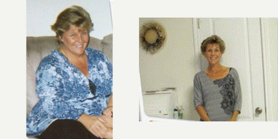 Gastric Bypass before and after photo