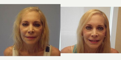 Hair Transplant before and after photo