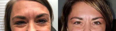 Botox before and after photo