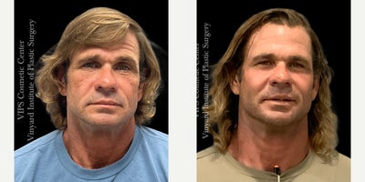 Botox before and after photo