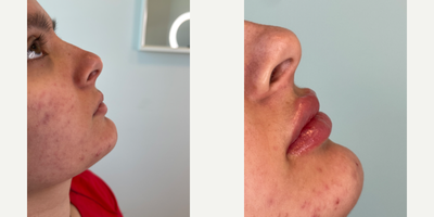 Dermal Fillers before and after photo