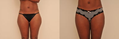 Liposuction before and after photo
