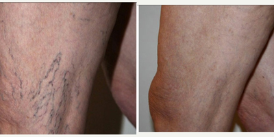 Sclerotherapy before and after photo