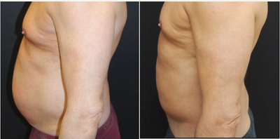 Tummy Tuck before and after photo