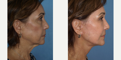 Facial Fat Transfer before and after photo