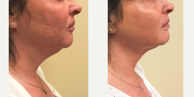 Kybella before and after photo