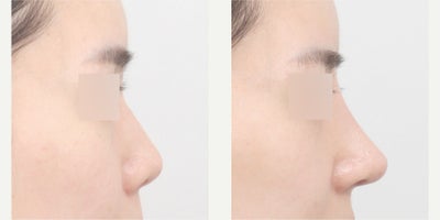 Asian Rhinoplasty before and after photo