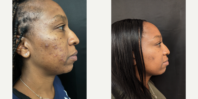 AviClear before and after photo