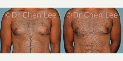 Gynecomastia Surgery before and after photo