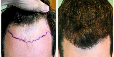 Hair Transplant before and after photo