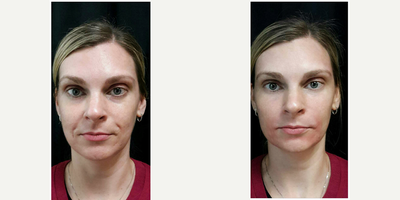 Juvederm before and after photo