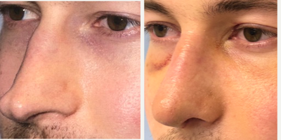 Rhinoplasty before and after photo