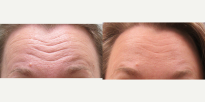 Botox before and after photo