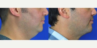 Buccal Fat Removal before and after photo